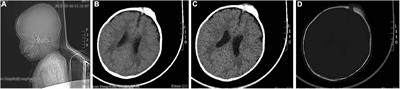 A case report of melanotic neuroectodermal tumor of infancy complicated with congenital heart disease and hypothyroidism